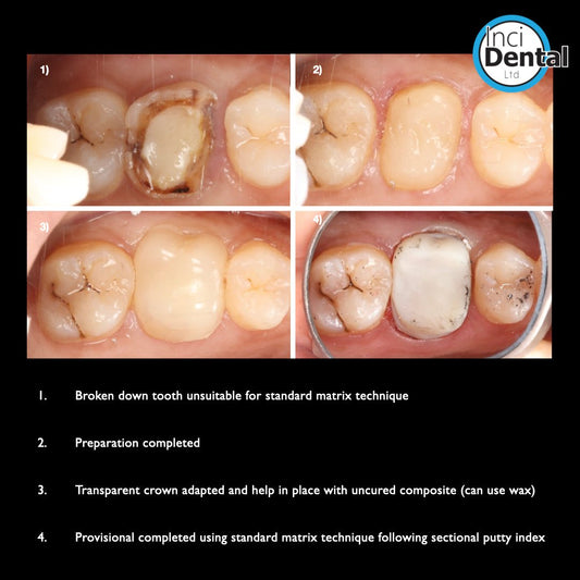 Anterior Transparent Crowns (64 pcs) - Incidental