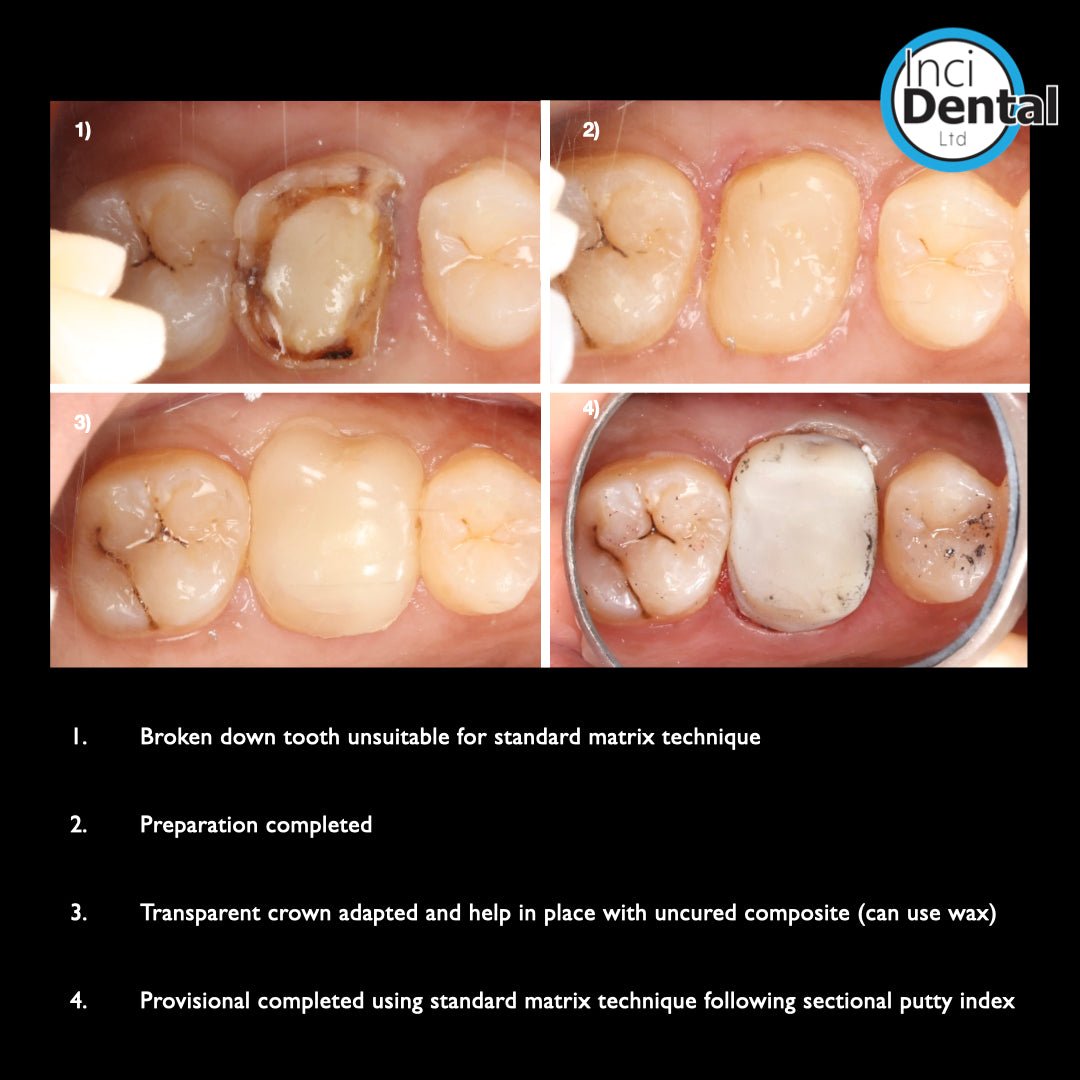 Posterior Transparent Crowns (64 pcs) - Incidental